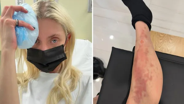 Taylor Momsen Hospitalized a Week After Spider Bite on AC/DC Tour